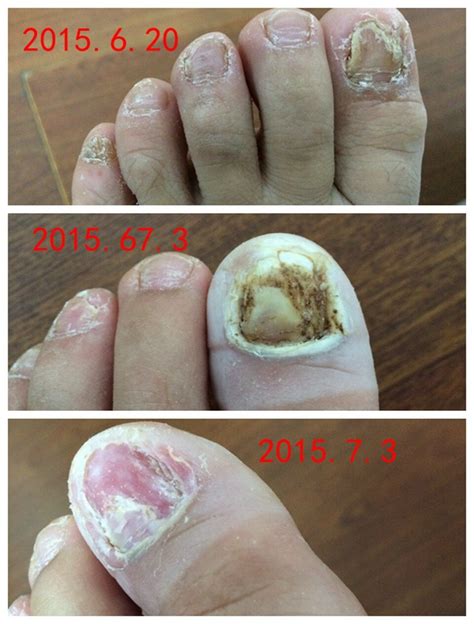 Toe Nail Fungus Gray Nail Special Traditional Chinese Natural Nail