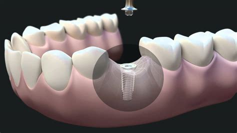 Dental Implants The Complete Procedure Youtube
