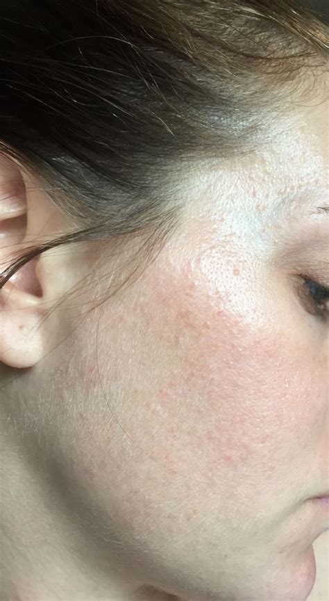 Re Small Rash Like Bumps All Over Face Beauty Insider Community