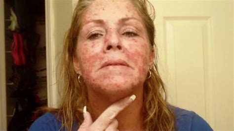 Skin Cancer My Vlog Journal Treatment W Efudex Vid Youtube