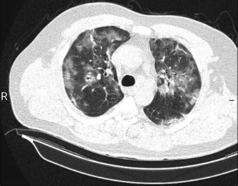 Chest Ct Scan Without Contrast Showing Covid 19 Pneumonia Download