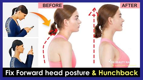 Just 5 Minutes How To Fix Forward Head Posture And Fix Hunchback