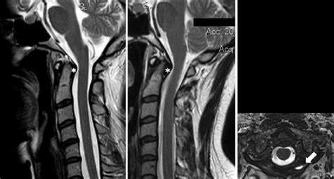 A Magnetic Resonance Imaging Mri Of The Cervical Spine T2 Weighted
