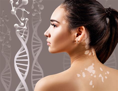 What Is Vitiligo Causes Signs Symptoms And More Vitiligo Society