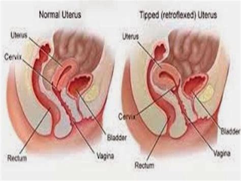 Exercises For A Retroverted Uterus Retroverted Uterus Uterus Cervix