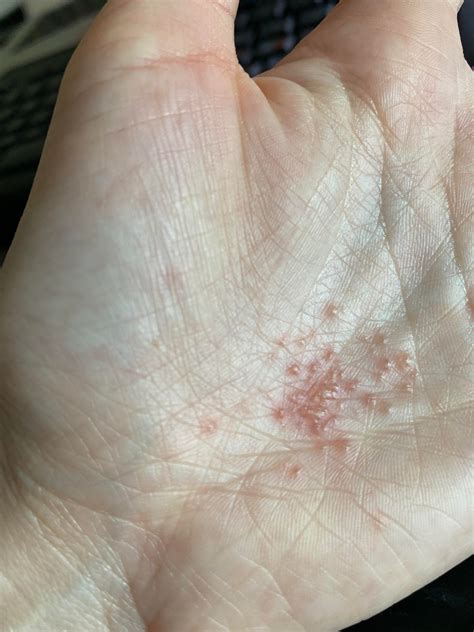 Does This Look Like Eczema I Thought It May Be Scabies But Its Only