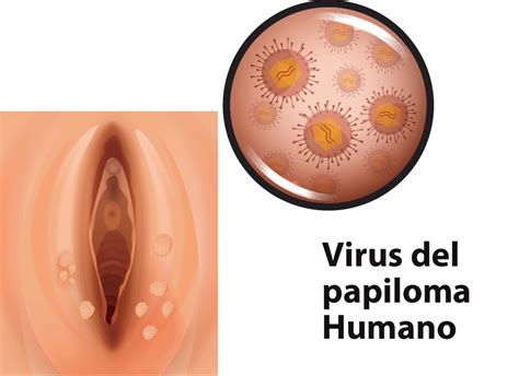 Imagen De Virus Papiloma Humano Hot Sex Picture