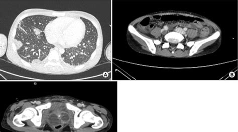 Preoperative Chest And Abdominopelvic Computed Tomography A Multiple
