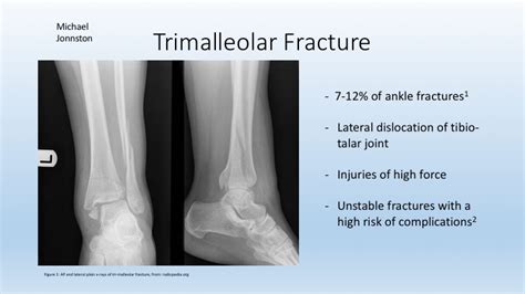 Trimalleolar Ankle Fracture — Learned