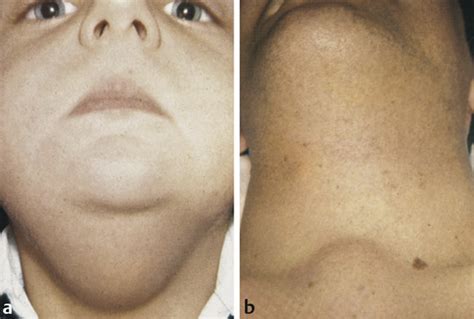 Neck Masses In Children Congenital Neck Disease Ento Key