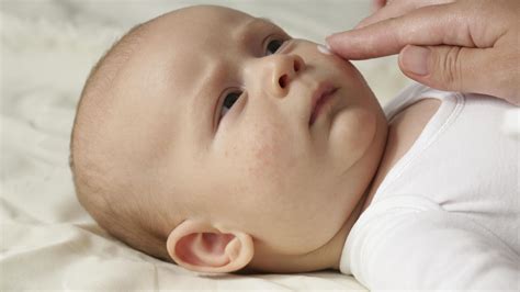 26 Baby Acne Or Rash Background Acne Problems