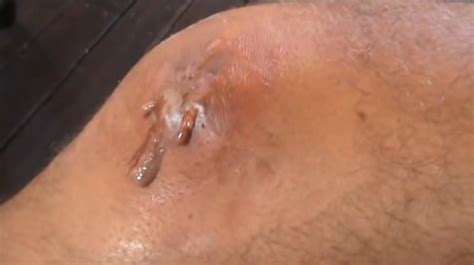 Youtube Abscess Popping New Pimple Popping Videos
