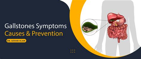 Gallstones Symptoms Causes Prevention Gallstone Specialist