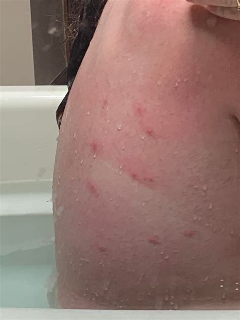 Do These Look Like Bedbug Bites More Pics In Comments There Are Like