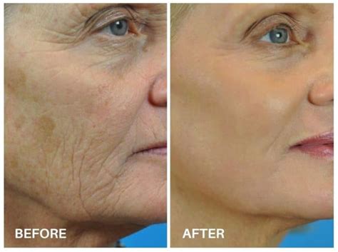 Laser Skin Resurfacing Treats Wrinkles Unwanted Pigmentation And More