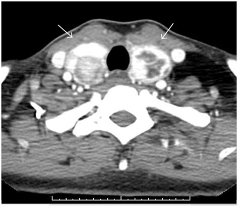 Axial Postcontrast Ct Image Through The Thyroid Gland D Open I