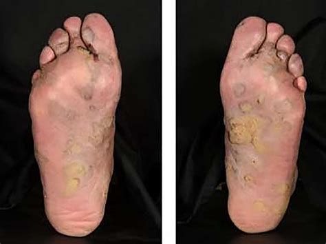 Skin Rashes On Feet