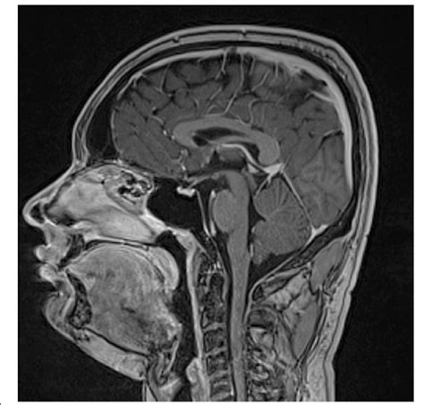 Magnetic Resonance Image Of The Brain Sagittal View Showing The