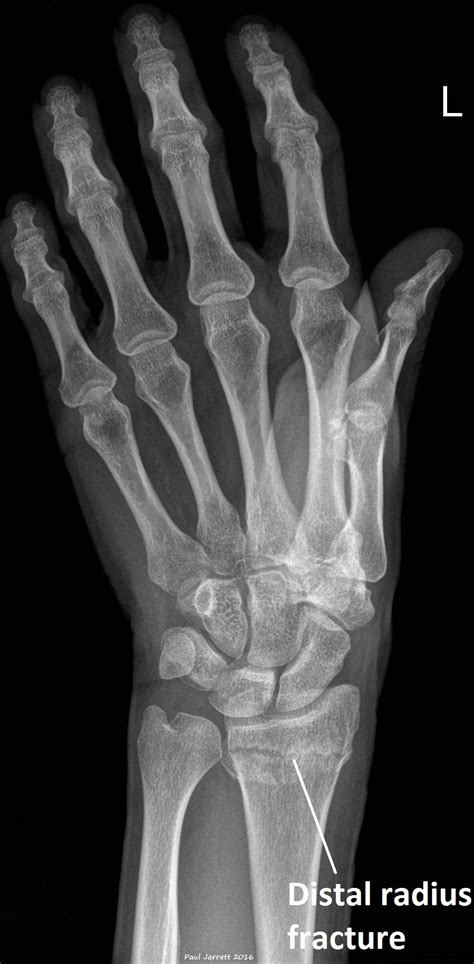 Mr Paul Jarrett Distal Radial Fractures Murdoch Orthopaedic Clinic