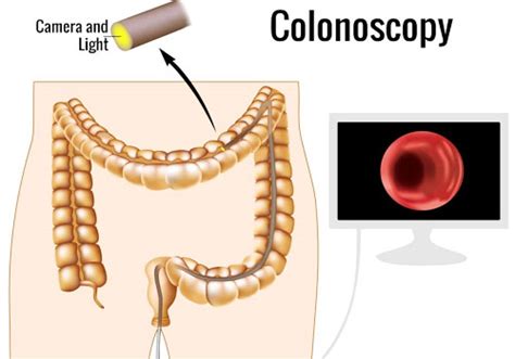 A colon is also used when direct speech is introduced by a name. What You Need to Know about Colon Cancer - Medical India Tourism Blog