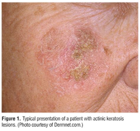 Actinic Keratosis As Related To Fluorouracil Pictures