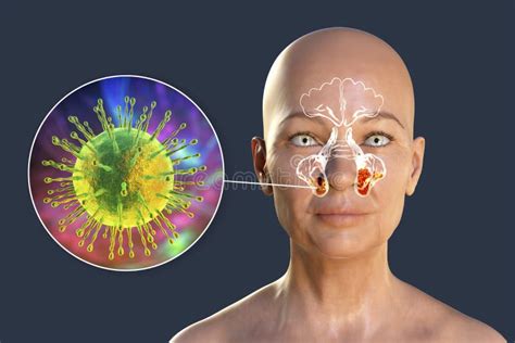 Rinitis Viral De La Sinusitis Causada Por El Adenovirus Ilustración Del