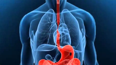 La espondilolistesis, puede causar estenosis espinal; ESTENOSIS ESOFAGICA BENIGNA PDF