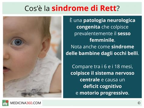 Sindrome di Rett che cos è sintomi diagnosi cause e possibili cure