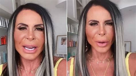 Gretchen mostra como está o rosto uma semana após harmonização E agora O que vocês têm para