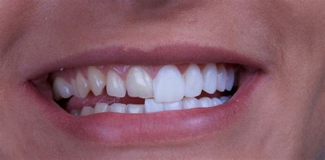 porcelain veneers cosmetic dentistry dentist belfast cranmore dental