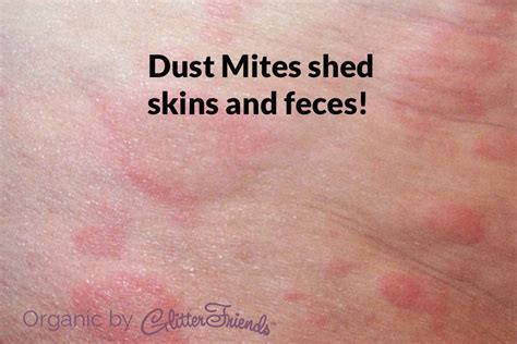 Dust Mites Bed Bug Bites Pictures Bed Bug Bites Bed Bugs