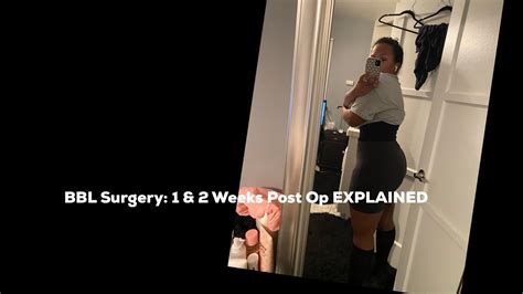 Bbl Surgery 1 And 2 Weeks Post Op Update Part One Youtube