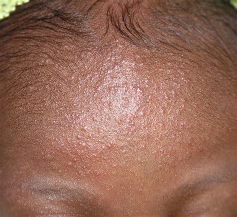 Neonatal Acne Acne Picture