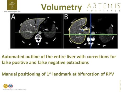 Tpct Triphasic Ct Scan Liver