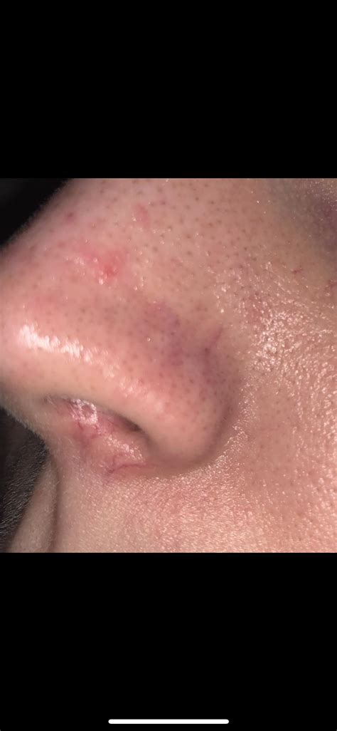 Skin Concerns Does Anyone Know What Treatment I Need To Get Rid Of