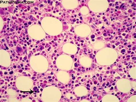 Pathology Outlines Pure Red Cell Aplasia