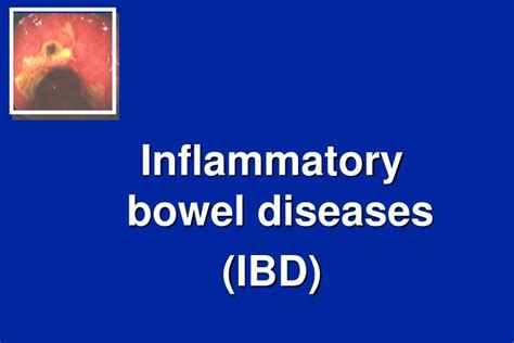 Ppt Inflammatory Bowel Diseases Ibd Powerpoint Presentation Free Download Id2885669