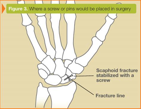 Fracture Of Scaphoid Fracture Healing Scaphoid Fracture Medical Art