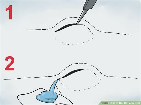 Ways To Get Rid Of A Cyst Wikihow