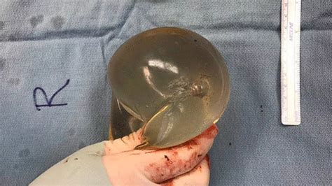 Boob Job Saves Womans Life As Close Range Bullet Deflects Off Silicone Implant Mirror Online