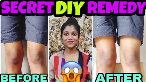 Lighten Dark Knees And Elbows Fast 100 Naturally At Home ️ Youtube