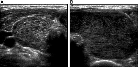 Ultrasound Of Primary Thyroid Non Hodgkins Lymphoma Clinical Imaging
