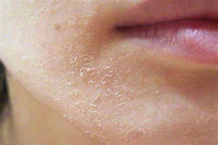 Dry Rough Skin Causes And Their Natural Solutions