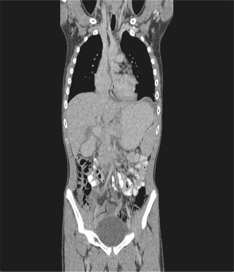 Ct Of Thorax Abdomen And Pelvic With Iv Contrast Coronal Plane