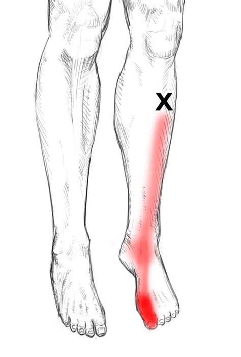 Tibialis Anterior Pain And Trigger Points