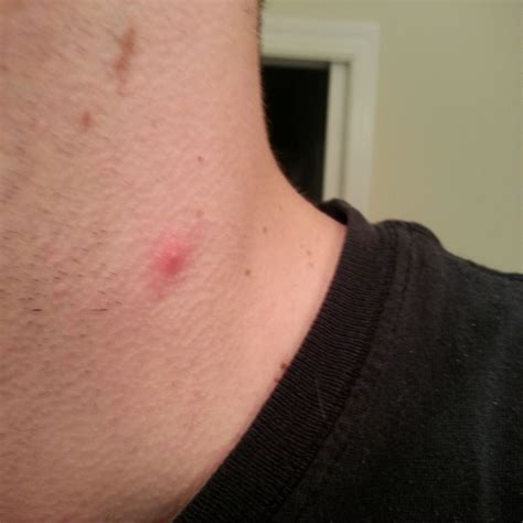 I Have Two Red Bumps On Neck And Jaw