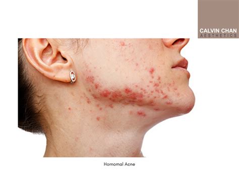 Our Complete Guide To Acne Care How To Identify And Treat Different