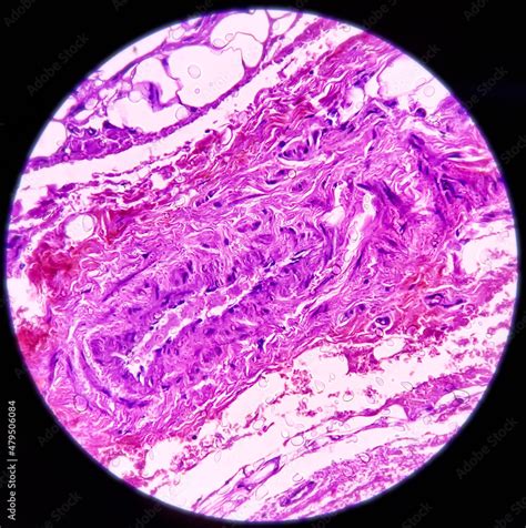 Chest Wall Cystbiopsy Epidermal Inclusion Cyst Commonly Called