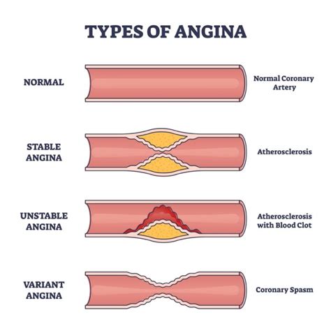 Angina Treatment And Symptoms The Causes Of Angina