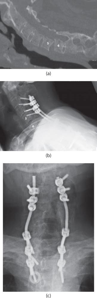 Cervical Spine Fractures Musculoskeletal Key